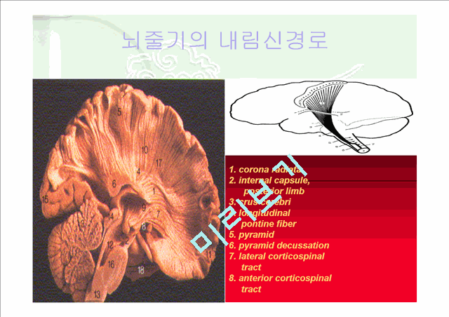 [의학]신경계case - 뇌간손상[Brain stem lesion]에 관해   (8 )